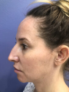 before rhinoplasty left side view of female patient 2825