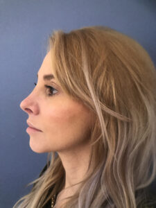 after rhinoplasty left side view of female patient 2825