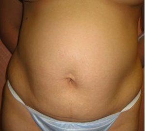 before tummy tuck front view of female patient 3071