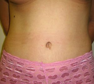 after tummy tuck front view of female patient 3071