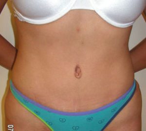 after tummy tuck front view of female patient 3085