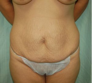 before tummy tuck front view of female patient 3106