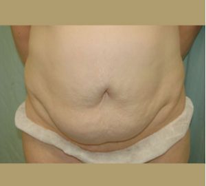 before tummy tuck front view of female patient 3113