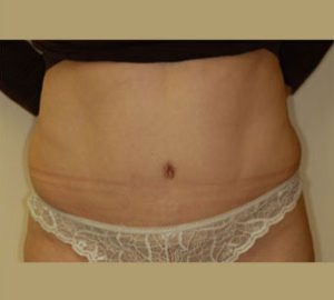 after tummy tuck front view of female patient 3113