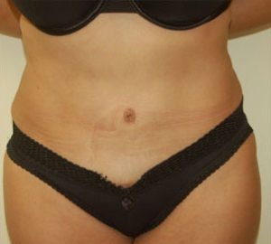 after tummy tuck front view of female patient 3148
