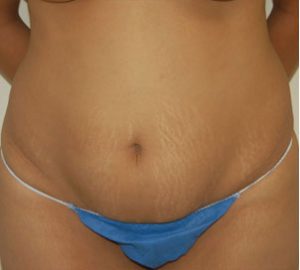 tummy tuck front view of female patient 3183