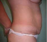 before tummy tuck right side view of female patient 3190