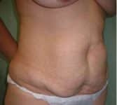 before tummy tuck right angle view of female patient 3190