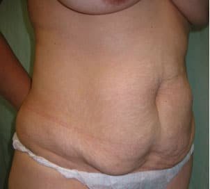 before tummy tuck right angle view of female patient 3190