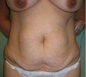 before tummy tuck front view of female patient 3190