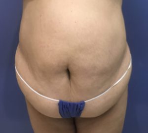 before tummy tuck front view of female patient 3205
