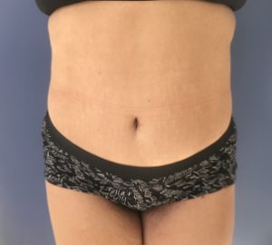 after tummy tuck front view of female patient 3205