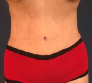 after tummy tuck front view of female patient 3212