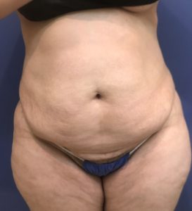 before tummy tuck front view of female patient 3219