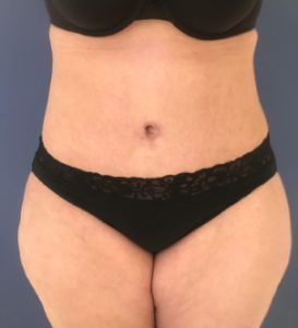 after tummy tuck front view of female patient 3219