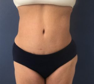 after tummy tuck front view of female patient 3247