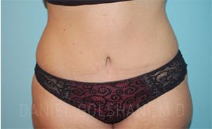 after tummy tuck front view of female patient 3268