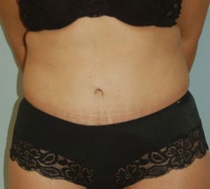 after tummy tuck front view of female patient 3296