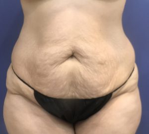 before tummy tuck front view of female patient 3303