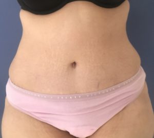 after tummy tuck front view of female patient 3303