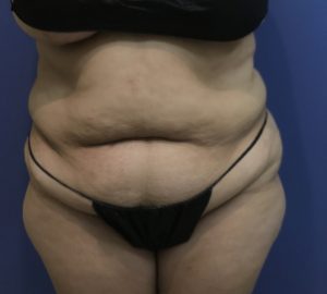 before tummy tuck front view of female patient 3316