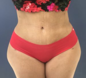 after tummy tuck front view of female patient 3316