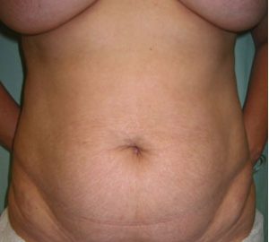before Brazilian liposculpture front view of female patient 3366