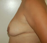 before breast lift left side view of female patient 4316