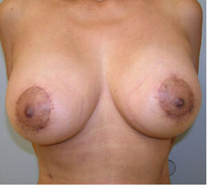 after breast lift front view of female patient 4345