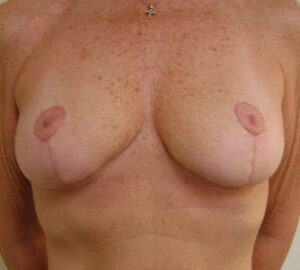 after breast reduction front view of female patient 4769