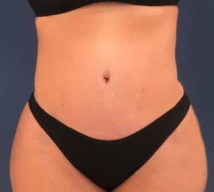 after tummy tuck front view of female patient 5260