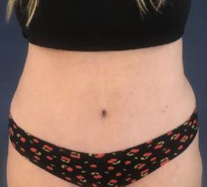 after tummy tuck front view of female patient 5274