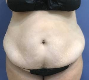 before before tummy tuck front view of female patient 5274