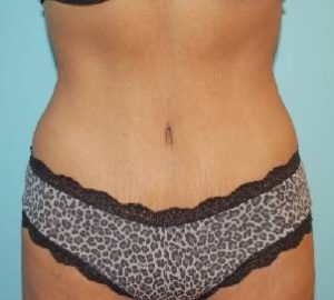 after tummy tuck front view of female patient 5285
