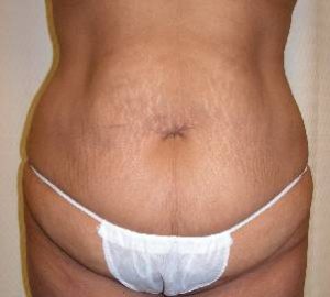 before tummy tuck front view of female patient 5285