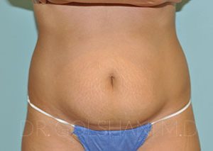 before tummy tuck front view female patient case 6797