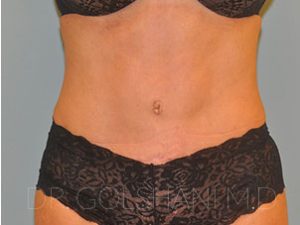 after tummy tuck front female patient case 6804